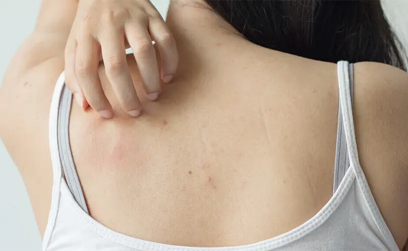 Mengatasi Jerawat Tubuh di Area Dada dan Punggung