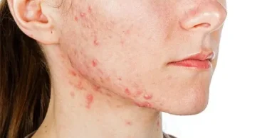 Skincare untuk Jerawat Hormonal