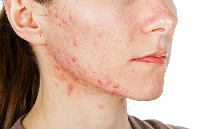 Skincare untuk Jerawat Hormonal