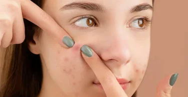 Mitos vs Fakta Seputar Jerawat