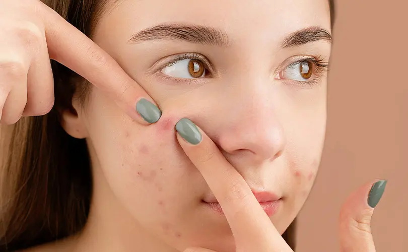 Mitos vs Fakta Seputar Jerawat